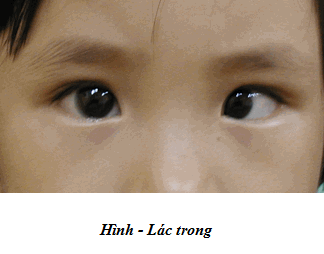 Lác trong
