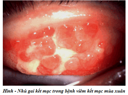 Viêm kết mạc