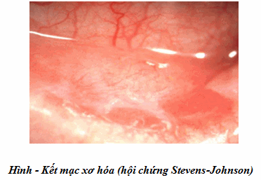 Xơ hóa kết mạc