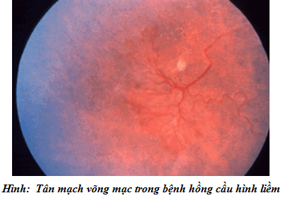 Tân võng mạc