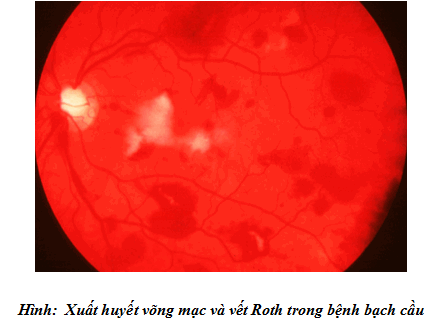 Xuất huyết võng mạc