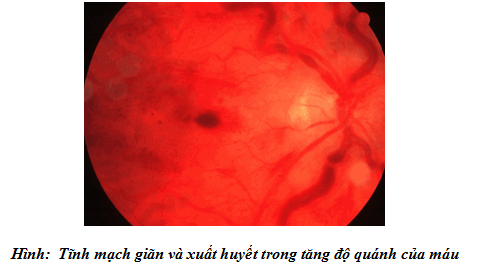 Tĩnh mạch giãn