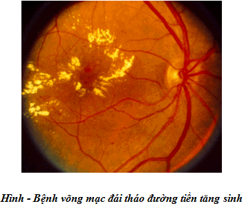 Võng mạc do đái đường