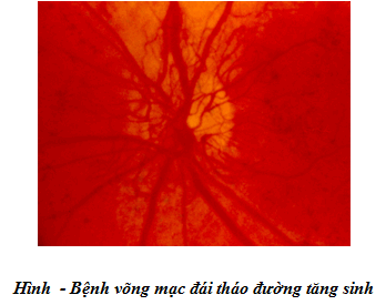 Bệnh võng mạc do đái đường