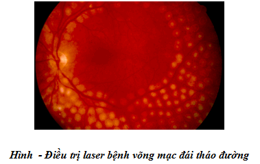 Điều trị laser