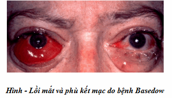 Lồi mắt basedow