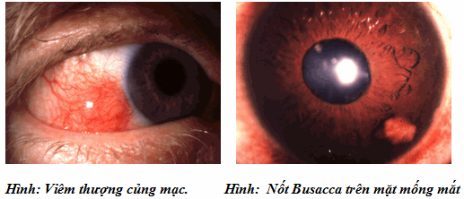 Viêm thượng củng mạc mắt
