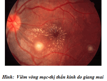 Viêm mắt giang mai