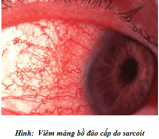 Viêm màng bồ đào