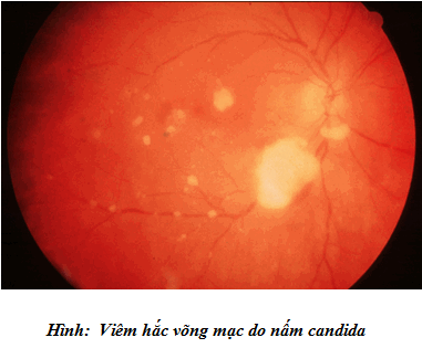 Viêm mắt do nấm Candida