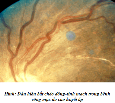 Dấu hiệu bắt chéo