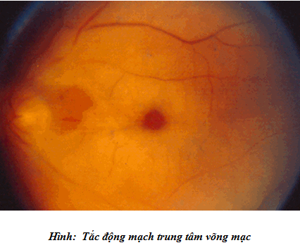 Các bệnh tim mạch khác