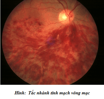 Tắc tĩnh mạch võng mạc