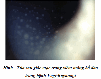 Bệnh mắt Vogt-Koyanagi-Harada