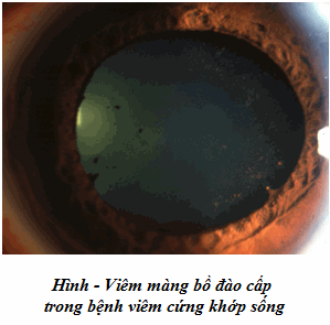 Bệnh mắt viêm cứng khớp sống