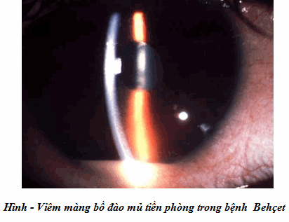 Bệnh mắt viêm cứng khớp sống