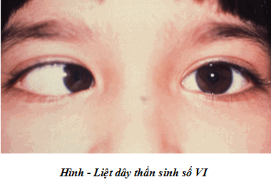 Liệt thần kinh mắt