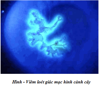 Viêm giác mạc thần kinh