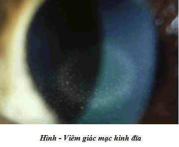 Viêm giác mạc