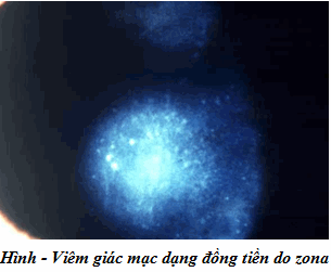 Viêm giác mạc