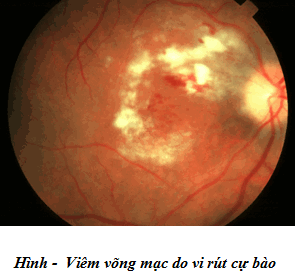 Viêm võng mạc vi rút