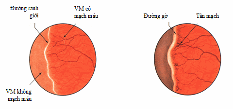 Bệnh võng mạc trẻ đẻ non giai đoạn 1 và 2