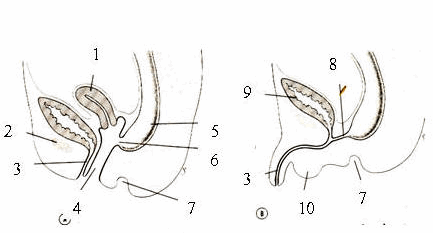 Rò trực tràng âm đạo