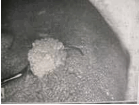U nhú (Papilloma)