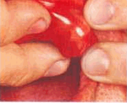 U hỗn hợp (Mixed tumor)