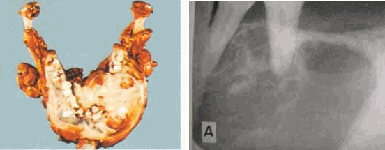 U men (Améloblastoma)