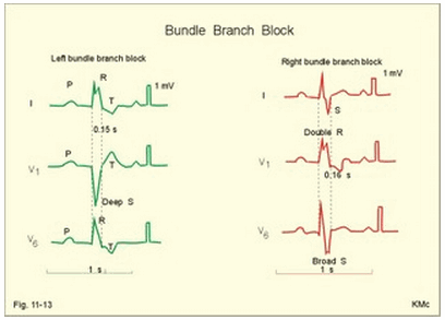 Phức bộ QRS bệnh lý