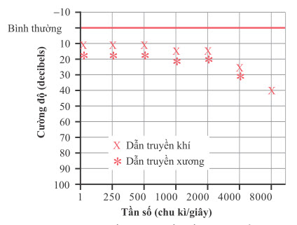 Thính lực đồ của loại điếc thần kinh tuổi già