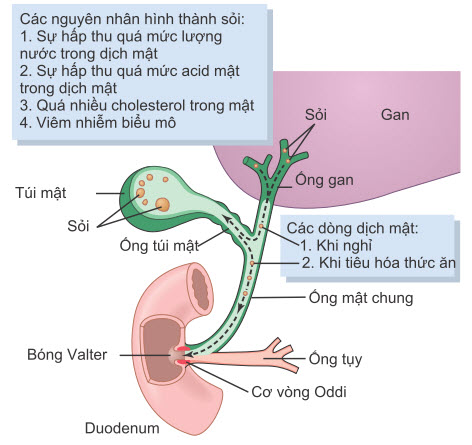 Hình thành sỏi mật