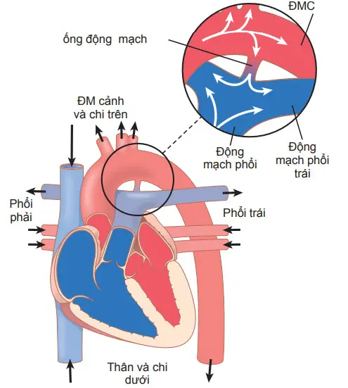 Còn ống động mạch