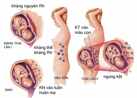 Tai biến sản khoa trong bất đồng nhóm máu Rhesus