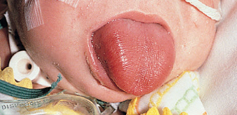 Phì đại lưỡi ở trẻ nhũ nhi