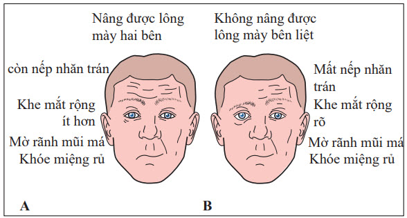 Biểu hiện đặc trưng của liệt mặt