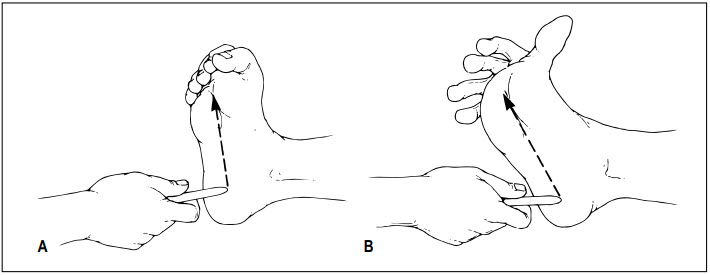 Kiếm tra dấu hiệu Babinski