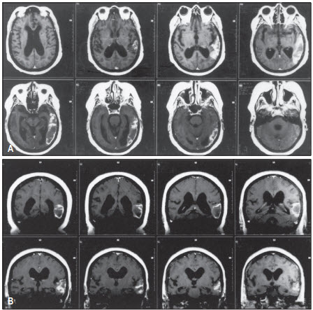 MRI của bệnh nhân thất ngôn Wernicke 