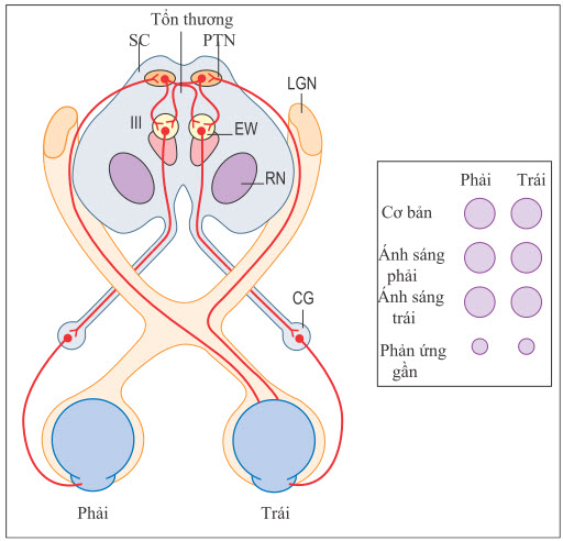 Phản ứng của đồng tử trong phân ly ánh sáng nhìn gần do tổ thương nhân trước mái