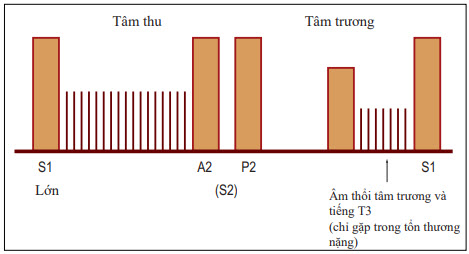 Thời gian và hình dạng của âm thổi hở van hai lá