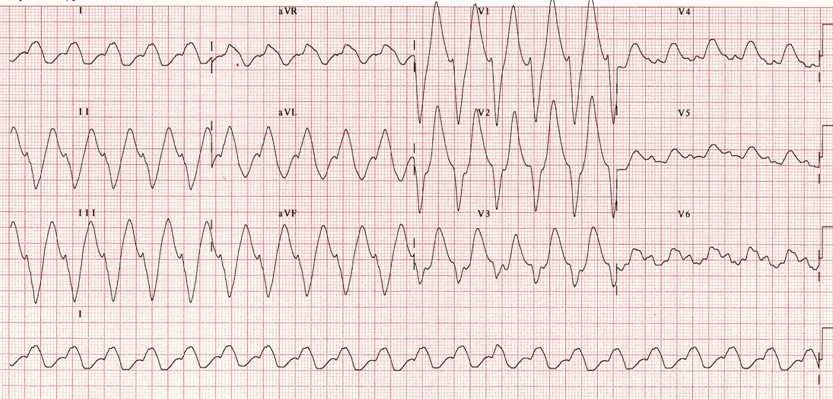 ECG hiển thị cùng một bệnh nhân ngộ độc TCA