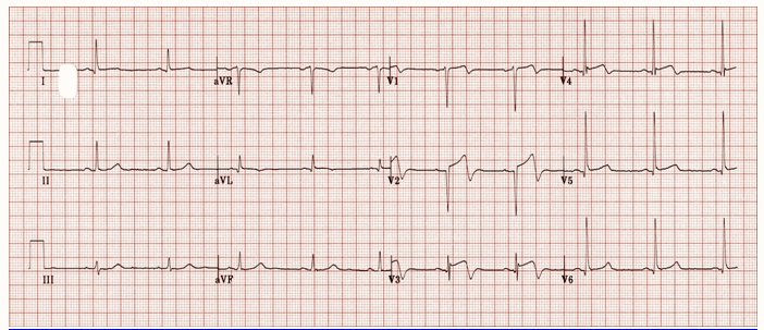 Hội chứng Wellens (Loại A Pattern)