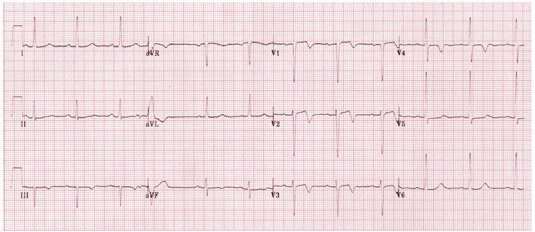 Hội chứng Wellens (Loại A Pattern)