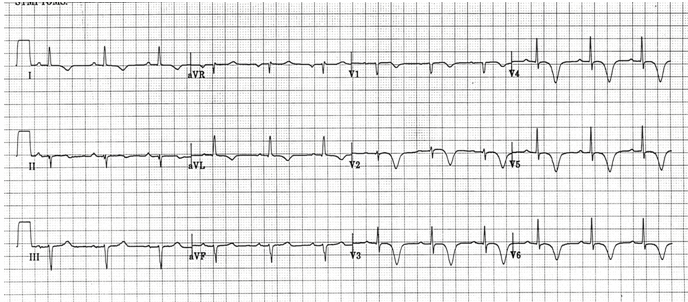 Hội chứng Wellens (Type mẫu B)