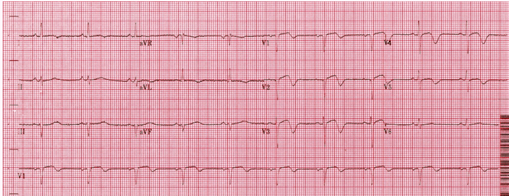 Hội chứng Wellens (Loại A Pattern)