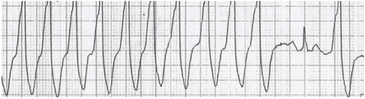 Nút xoang ngừng dẫn tới tâm thất tạo ra nhịp có phức QRS hẹp