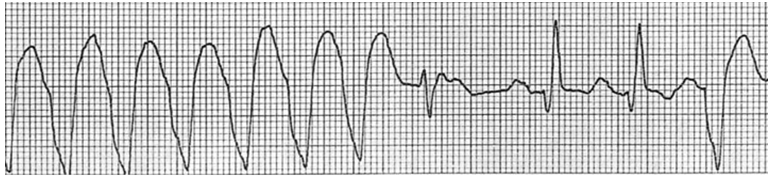 Phức bộ QRS hẹp là một nhịp hỗn hợp