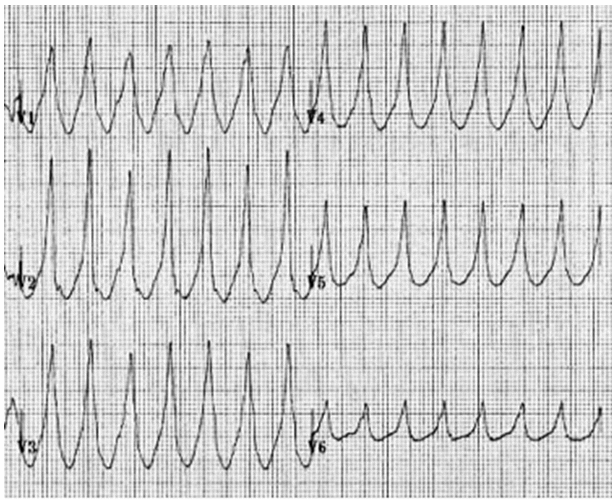 Sự phù hợp dương trong các đạo trình trước tim