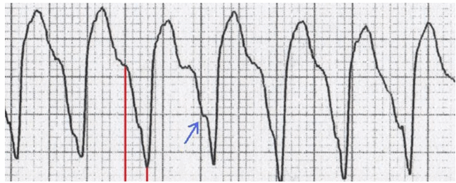 Dấu hiệu Brugada 